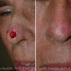 Reconstructive Surgery Before and After Photos in Miami, FL, Patient 15839