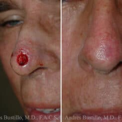 Reconstructive Surgery Before and After Photos in Miami, FL, Patient 15839