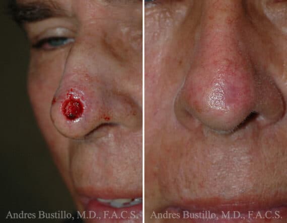 Reconstructive Surgery Before and After Photos in Miami, FL, Patient 15839