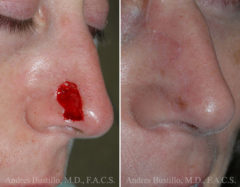 Reconstructive Surgery Before and After Photos in Miami, FL, Patient 15845