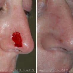 Reconstructive Surgery Before and After Photos in Miami, FL, Patient 15845