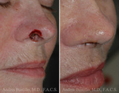 Reconstructive Surgery Before and After Photos in Miami, FL, Patient 15848