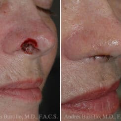 Reconstructive Surgery Before and After Photos in Miami, FL, Patient 15848