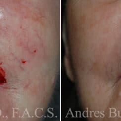 Reconstructive Surgery Before and After Photos in Miami, FL, Patient 15851