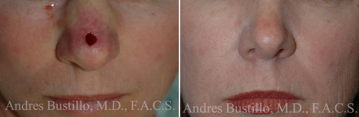 Reconstructive Surgery Before and After Photos in Miami, FL, Patient 15854