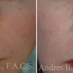 Reconstructive Surgery Before and After Photos in Miami, FL, Patient 15854