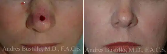 Reconstructive Surgery Before and After Photos in Miami, FL, Patient 15854