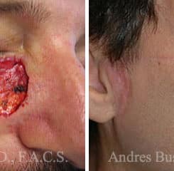 Reconstructive Surgery Before and After Photos in Miami, FL, Patient 15857