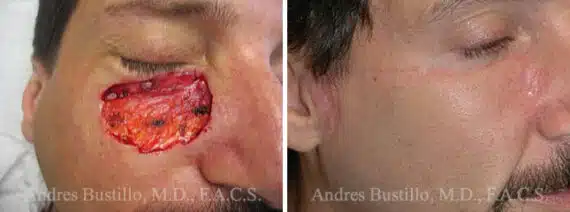 Reconstructive Surgery Before and After Photos in Miami, FL, Patient 15857