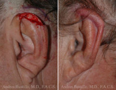 Reconstructive Surgery Before and After Photos in Miami, FL, Patient 15860