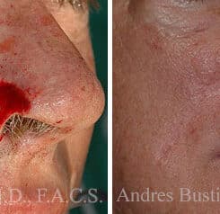 Reconstructive Surgery Before and After Photos in Miami, FL, Patient 15863