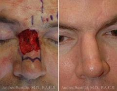 Reconstructive Surgery Before and After Photos in Miami, FL, Patient 15866