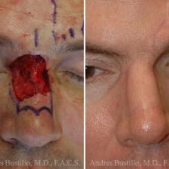 Reconstructive Surgery Before and After Photos in Miami, FL, Patient 15866