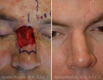 Reconstructive Surgery Before and After Photos in Miami, FL, Patient 15866