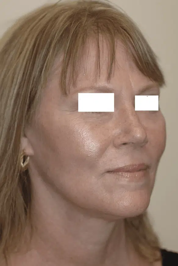 Oblique view of the same patient after having a facial lifting and eyelid lift by Dr. Bustillo. The midface has been elevated and a youthful contour has been re-established.