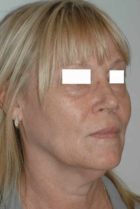 Oblique view of a female before a facelift in Miami. Notice the descent of the midface (cheek). Hollowness can be seen in the area between the lower eyelid and cheek.