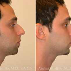 Rhinoplasty Before and After Photos in Miami, FL, Patient 15526