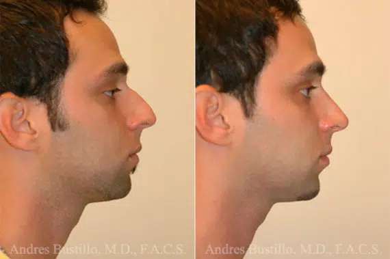 Rhinoplasty Before and After Photos in Miami, FL, Patient 15526