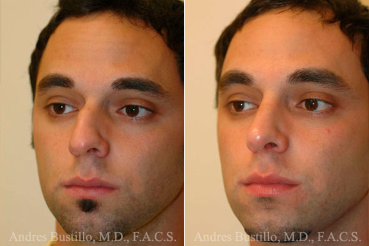 Rhinoplasty Before and After Photos in Miami, FL, Patient 15526