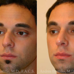 Rhinoplasty Before and After Photos in Miami, FL, Patient 15526