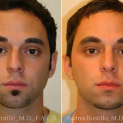 Rhinoplasty Before and After Photos in Miami, FL, Patient 15526