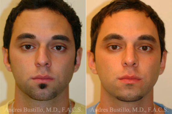 Rhinoplasty Before and After Photos in Miami, FL, Patient 15526