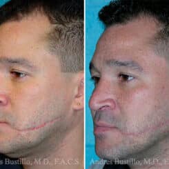 Reconstructive Surgery Before and After Photos in Miami, FL, Patient 15827