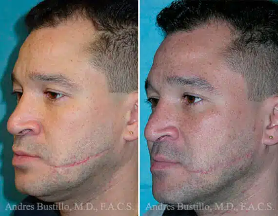 Reconstructive Surgery Before and After Photos in Miami, FL, Patient 15827