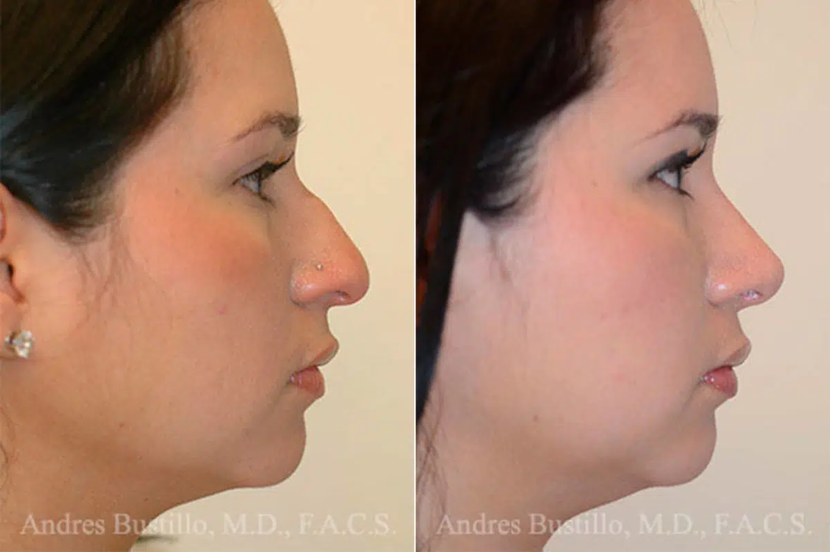 Rhinoplasty Before and After Photos in Miami, FL, Patient 15872