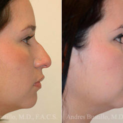 Rhinoplasty Before and After Photos in Miami, FL, Patient 15872