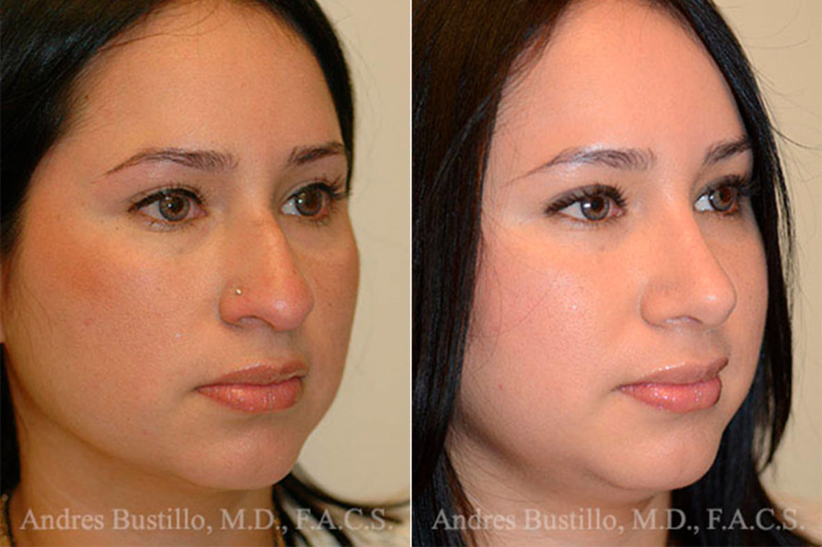 Rhinoplasty Before and After Photos in Miami, FL, Patient 15872