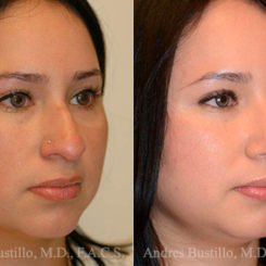 Rhinoplasty Before and After Photos in Miami, FL, Patient 15872