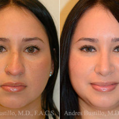 Rhinoplasty Before and After Photos in Miami, FL, Patient 15872