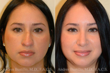 Rhinoplasty Before and After Photos in Miami, FL, Patient 15872