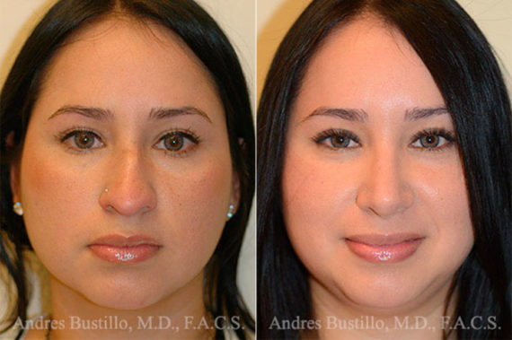 Rhinoplasty Before and After Photos in Miami, FL, Patient 15872