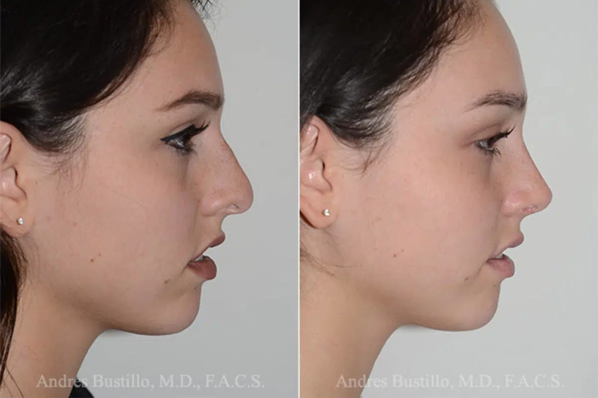 Rhinoplasty Before and After Photos in Miami, FL, Patient 16883