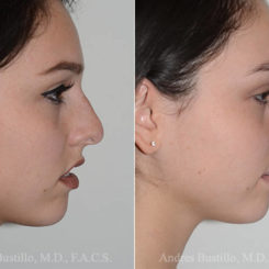 Rhinoplasty Before and After Photos in Miami, FL, Patient 16883