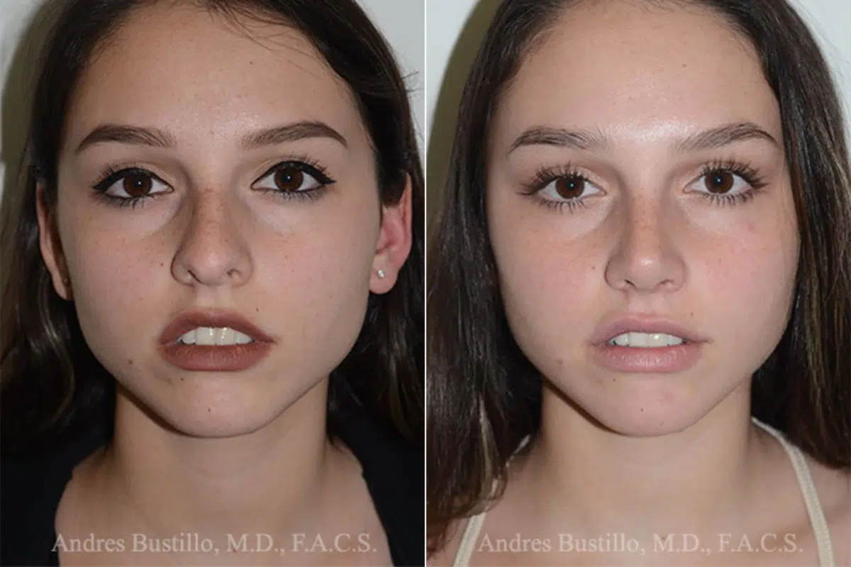 Rhinoplasty Before and After Photos in Miami, FL, Patient 16883