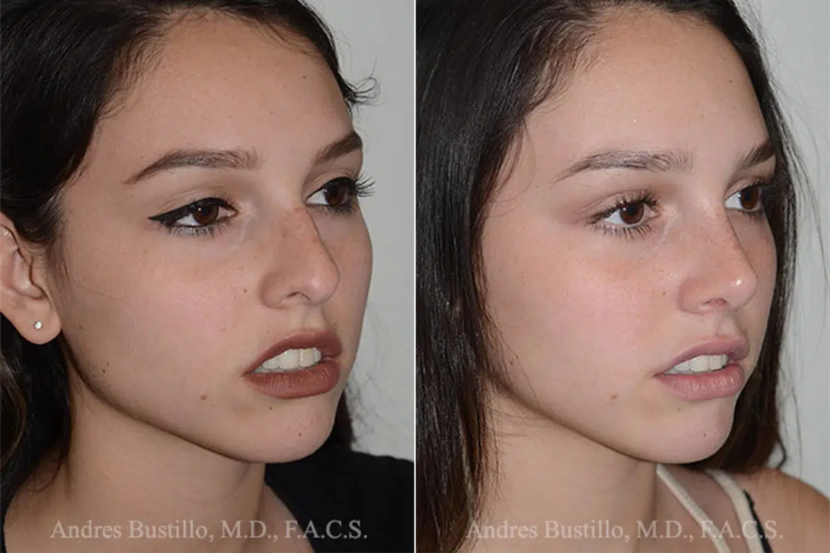 Rhinoplasty Before and After Photos in Miami, FL, Patient 16883