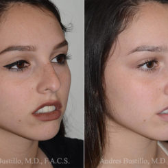 Rhinoplasty Before and After Photos in Miami, FL, Patient 16883