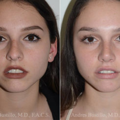 Rhinoplasty Before and After Photos in Miami, FL, Patient 16883