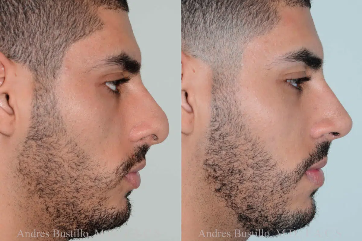 Rhinoplasty Before and After Photos in Miami, FL, Patient 17837