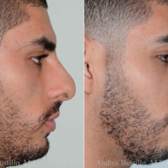 Rhinoplasty Before and After Photos in Miami, FL, Patient 17837