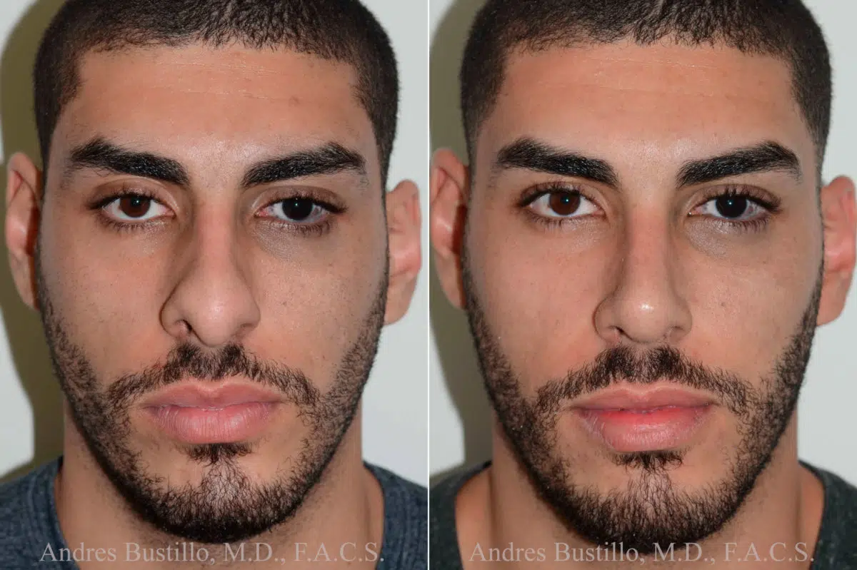 Rhinoplasty Before and After Photos in Miami, FL, Patient 17837