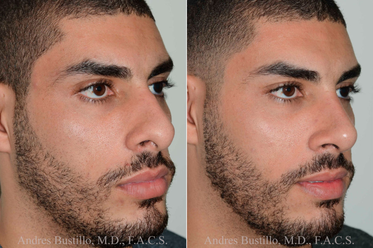 Rhinoplasty Before and After Photos in Miami, FL, Patient 17837