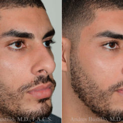 Rhinoplasty Before and After Photos in Miami, FL, Patient 17837