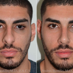 Rhinoplasty Before and After Photos in Miami, FL, Patient 17837