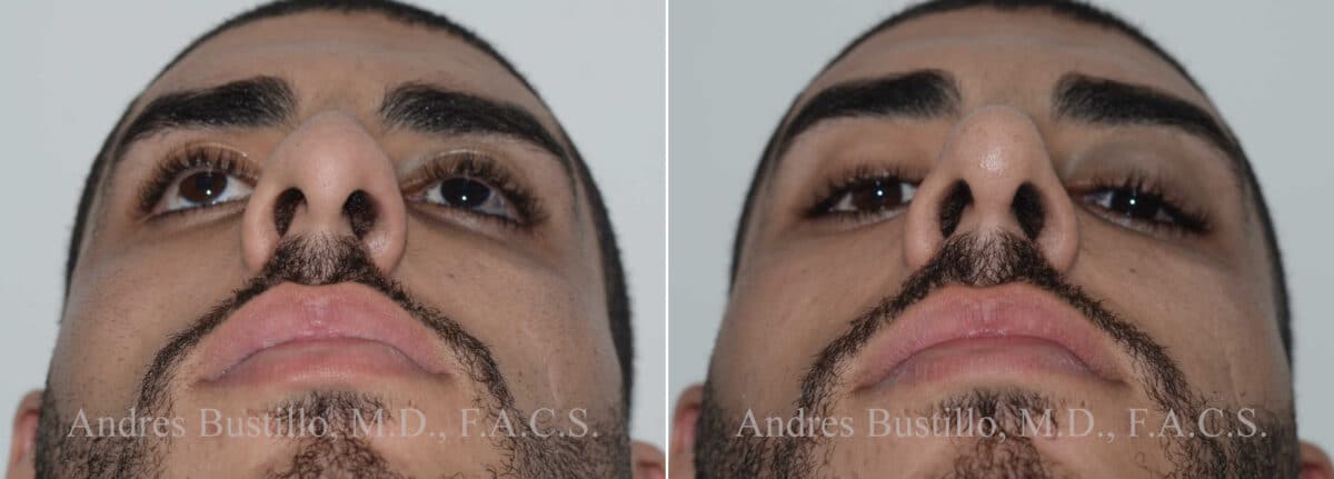 Rhinoplasty Before and After Photos in Miami, FL, Patient 17837