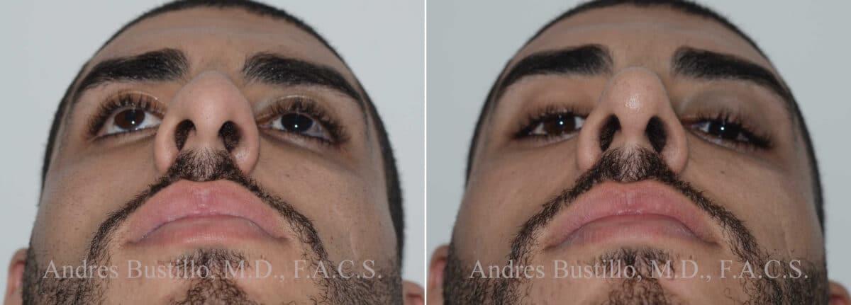 Rhinoplasty Before and After Photos in Miami, FL, Patient 17837