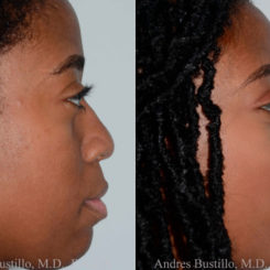 Rhinoplasty Before and After Photos in Miami, FL, Patient 17855